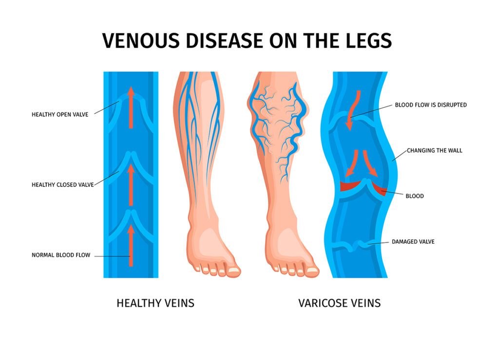 Cross-section comparison of healthy vein and varicose vein with damaged valves in the leg