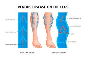 Cross-section comparison of healthy vein and varicose vein with damaged valves in the leg