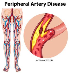 PAD is a serious vascular condition that can lead to limb loss if left untreated.