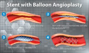 Diagram showing balloon angioplasty, a procedure in Interventional Radiology: 1. Cholesterol buildup narrows artery. 2. Balloon with stent inserted. 3. Balloon inflates, expanding stent. 4. Balloon is removed, leaving expanded stent in place. - ARIA Vascular | vascular surgery and interventional Radiology