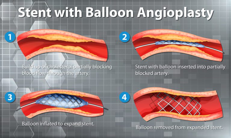 Diagram showing balloon angioplasty, a procedure in Interventional Radiology: 1. Cholesterol buildup narrows artery. 2. Balloon with stent inserted. 3. Balloon inflates, expanding stent. 4. Balloon is removed, leaving expanded stent in place. - ARIA Vascular | vascular surgery and interventional Radiology