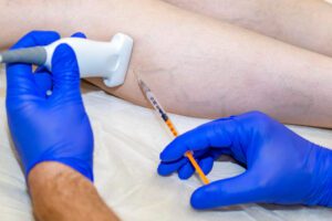 A close-up of gloved hands performing an Interventional Radiology procedure on a person's leg. One hand holds an ultrasound device, while the other guides a syringe needle into the skin. - ARIA Vascular | vascular surgery and interventional Radiology