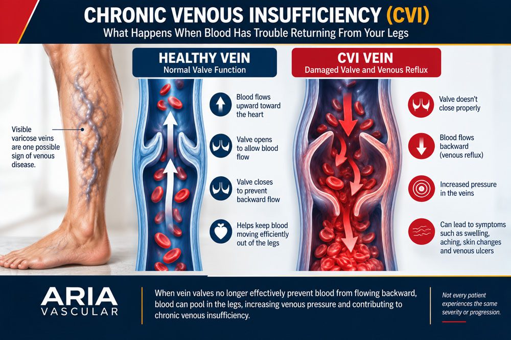 Healthy leg vein compared with a vein affected by chronic venous insufficiency and venous reflux
